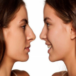How to Prepare for Rhinoplasty in Dubai