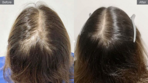 Can Finasteride Make Hair Loss Worse?