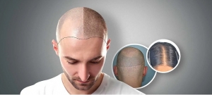 Who is a Candidate for Scalp Micropigmentation in Dubai?